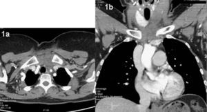 TAC torácico ventana mediastínica. a) Corte axial en mediastino superior con engrosamiento de la piel y tejido celular subcutáneo a nivel de línea medio cervical. b) Corte coronal donde se aprecia difuminación de la grasa paratraqueal izquierda extendiéndose a la grasa prevascular y retroesternal en mediastino superior.