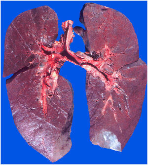Los pulmones presentaban a la sección aspecto hemorrágico difuso y pérdida del aspecto «esponjoso» normal, con solidificación extensa.