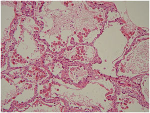 Detalle histológico del pulmón teñido con hematoxilina y eosina que muestra numerosos macrófagos con gránulos de color pardo claro en su interior. Las paredes alveolares no mostraron engrosamiento. No se observa vasculitis.