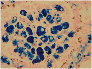 Tinción de perls que muestra en azul los gránulos de hemosiderina en el interior de los macrófagos.