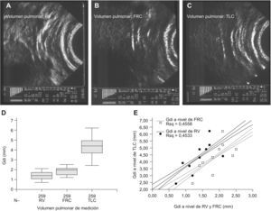 Fase de estudio estática in vivo. Imágenes representativas del diafragma y estructuras vecinas a nivel de la zona de aposición torácica del músculo obtenidas mediante ecografía bidimensional en voluntarios sanos. El diafragma muestra un grosor mínimo a volumen residual (RV) (A), intermedio a capacidad funcional residual (FRC) (B), y máximo a capacidad pulmonar total (TLC) (C). La figura 2D muestra los valores absolutos obtenidos en estos volúmenes pulmonares. La figura 2E muestra la correlación lineal y su IC95% entre el Gdi máximo (a nivel de TLC) y el obtenido durante las maniobras de apnea a FRC y RV (p<0,05 ambos). Abreviaturas: N: número de mediciones; Gdi: grosor del diafragma; RV: volumen residual; TLC: capacidad pulmonar total; FRC: capacidad funcional residual.