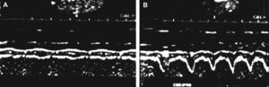 Fase de estudio in vivo y dinámico Imágenes típicas obtenidas mediante la ecografía en modo M (guiada por el modo B) de los cambios de grosor del diafragma (Gdi) durante la respiración en reposo (A) y durante la respiración ante cargas inspiratorias específicas (B). El cambio (%) en el grosor durante las cargas no mostró correlación con el grosor en reposo (C). Abreviaturas: Gdi: grosor del diafragma; FRC: capacidad funcional residual.