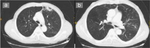 En la tomografía computarizada de tórax, se observa una imagen seudonodular en el campo pulmonar medio derecho (a). Tras el tratamiento antibiótico desaparecen las imágenes seudonodulares (b).