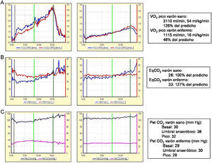 Parámetros ergoespirométricos en un varón sano de 45 años y otro de igual edad con HAP idiopática en clase funcional iii. A) Capacidad aeróbica: consumo de oxígeno (VO2). La línea verde vertical indica el umbral anaeróbico. B y C) Eficiencia ventilatoria. B) EqO2/EqCO2: equivalente ventilatorio para el oxígeno/dióxido de carbono. C) PetO2/CO2: presión parcial al final de la espiración de oxígeno/dióxido de carbono.