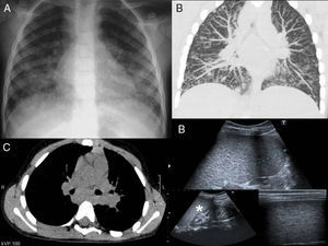 A. Rx de tórax, ensanchamiento de las bandas paratraqueales y aumento de tamaño hiliar secundario a la presencia de adenopatías. Aumentos de densidad mal definidos basales bilaterales, con tendencia a la confluencia, asociado a pequeñas imágenes nodulares. B. TC de tórax, opacidades nodulares en vidrio deslustrado y nódulos bien definidos distribuidos difusamente. Engrosamiento de septos interlobulillares. C. TC de tórax, adenopatías hiliares y subcarinales. D. Ecografía abdominal, esplenomegalia con presencia de multitud de lesiones focales hipoecogénicas de pequeño tamaño debidas a la presencia de granulomas. Aumento de ecogenicidad de las pirámides renales, ocasionado por depósitos de calcio y nefrocalcinosis. (asterisco).
