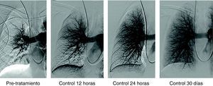 Paciente varón de 58 años con TEP masivo, shock con índice de Miller de 0.7 y presión arterial pulmonar media (PAP-m) de 42mm Hg. En el control de 12 horas después de tratamiento fibrinolítico (100.000 UI de UK/hora) mejoría del índice de Miller y PAP-m 38mm Hg y a las 24 horas PAP de 27mm Hg. El control de 30 días la PAP-m 18mm Hg. y el Índice de Miller de 0.