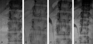 Recuperación de filtro de vena cava Gunther Tulip A Filtro en VCI. B Lazo recuperador. C Atrapamiento del filtro. D Introducción del filtro en vaina recuperadora.
