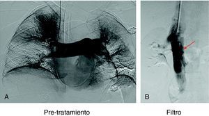 Paciente de 65 años en Shock, intubada, PO2 de 64 mm Hg. Índice de Miller 0,8 y PAP-m de 56 mm Hg. A la derecha implantación de filtro GT debajo de venas renales. Fallece de insuficiencia cardiaca derecha en las primeras 24 horas.