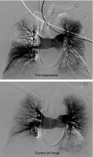 Paciente de 58 años TEP masivo. Shock. PAP-pm Pre-tratamiento48 mm Hg, índice de Miller 0.7. Postratamiento: PAP-m 32mm Hg, índice de Miller 0.