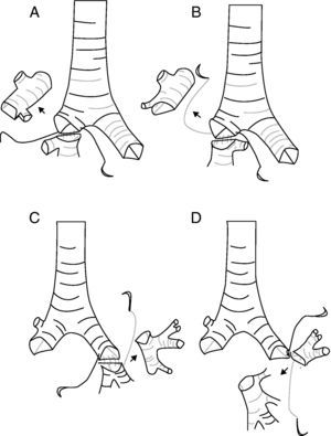 Diferentes tipos de sleeve lobectomías extendidas. A) Lóbulo superior derecho más lóbulo medio. B) Lóbulo superior derecho más segmento 6. C) Lóbulo superior izquierdo más segmento 6. D) Lóbulo inferior izquierdo más lingula.