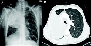 A) Radiografía de tórax posteroanterior que muestra gran masa en lóbulo superior derecho. B) Tomografia axial computarizada de tórax correspondiente al paciente.