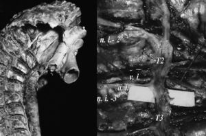 Anatomía simpático torácico. a.i.: arteria intercostal; n.i.-2°: 2° nervio intercostal; n.i.-3°: 3° nervio intercostal; T2: 2° ganglio simpático torácico; T3: 3° ganglio simpático toráco; v.i.: vena intercostal.