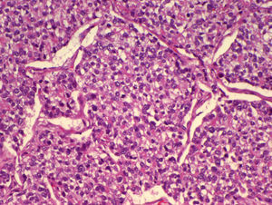 TDE H.E. 100×: detalle de la neoplasia pulmonar, que presenta un patrón sólido, con rasgos citoarquitecturales de diferenciación vitelina. (H.E., 100×).