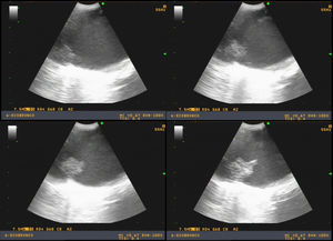 Arteria pulmonar principal izquierda con trombo flotante, visualizado de manera secuencial, con movimiento al compás del flujo (tamaño aproximado 5 mm).