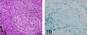 A) Biopsia transbronquial con tinción hematoxilina-eosina (×20) en la que se observa un granuloma con células histiocitarias, células gigantes multinucleadas (sin necrosis ni caseum) compatible con el diagnóstico de sarcoidosis. B) Tinción de Zielh-Nielsen (×40) de la biopsia transbronquial, sin demostración de bacilos de Koch.