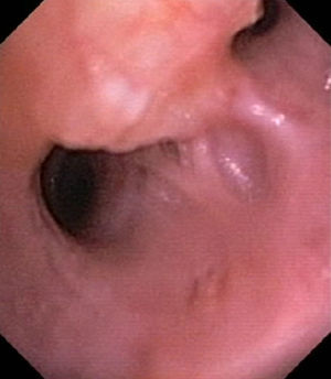 Imagen endoscópica en la que se aprecia mucosa edematosa y engrosada correspondiente a TCG.