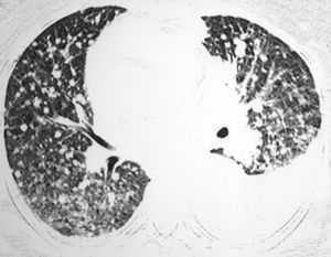 Imagen de TC de alta resolución de los lóbulos inferiores pulmonares, que muestra múltiples nódulos pequeños, mal definidos y de distribución aleatoria, así como áreas de atenuación en vidrio esmerilado en ambos pulmones. Se aprecia también un derrame pleural izquierdo.