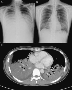 A) Radiografía de tórax, que mostraba infiltrados alveolares en ambos campos pulmonares. B) Tomografía computarizada de tórax, que mostraba consolidaciones difusas con broncograma aéreo en ambos lóbulos inferiores, una consolidación subsegmentaria en el segmento medial del lóbulo medio derecho y un derrame pleural mínimo. C) Tras el tratamiento con ribavirina inhalada, la radiografía de tórax puso de manifiesto una resolución evidente de la consolidación en los lóbulos inferiores de ambos pulmones.
