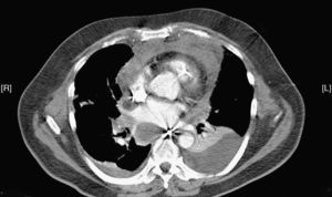 Imagen de la TC que muestra el ensanchamiento mediastínico, las colecciones con contenido aéreo, el derrame pleural bilateral y pericárdico y la atelectasia pulmonar compresiva.