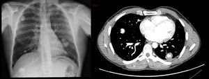 Radiografía y TC con nódulos pulmonares bilaterales.