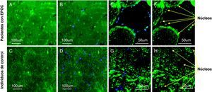 Imágenes en el microscopio de cortes musculares de cuádriceps de pacientes con EPOC e individuos ontrol, demostrándose en los miotúbulos la localización de YY1 con inmunohistoquímica en relación con los núcleos musculares. A-D: imágenes con microscopio de campo ancho y E-H: imágenes con microscopio confocal de cortes transversales de cuádriceps que demuestran la tinción de YY1 en verde y para los núcleos con 4’,6-diamidino-2-fenilindol en azul (B, D, E y G) y los mismos cortes que muestran tinción para YY1 sólo en verde (A, C, F y H). A, B, E y F muestran los cortes de un paciente en el que se identificó el patrón anómalo de tinción del factor tanto en el núcleo como en el citoplasma. C, D, G y H corresponden a un individuo de control en el que se demostró una tinción exclusivamente citoplasmática de YY1.