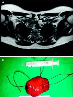 a) RM torácica donde se objetiva la masa a nivel de mediastino anterior. b) Imagen macroscópica de la masa resecada. Se trata de una formación nodular de 5 × 4 × 3,6 cm de superficie lisa con áreas de coloración pardo-violáceas.