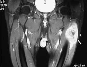 Resonancia magnética con secuencia potenciada en T2 que muestra una gran masa heterogénea (10×6,7cm) en el origen del vasto externo del muslo izquierdo, correspondiente a una metástasis en músculo esquelético (flecha).