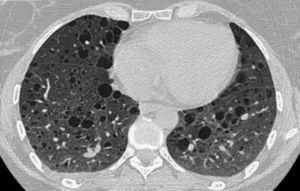 TC de tórax de una paciente con LAM donde se observan múltiples lesiones quísticas de pared fina distribuidas por ambos campos pulmonares.