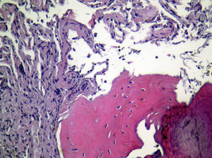 Biospia pleural por videotoracoscopia; tinción H-E. Engrosamiento de pleura visceral con formación de tejido óseo y normalidad de parénquima pulmonar subyacente.