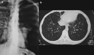 A) Radiografia de tórax posteroanterior realizada en el transcurso del estudio digestivo baritado. B) En la tomografía computarizada se observa un parénquima pulmonar con patrón micronodular.