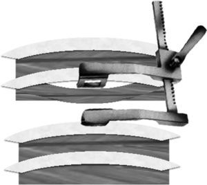 Separación intercostal previo colgajo para apoyo directo del separador sobre la costilla, evitando la compresión del paquete intercostal.