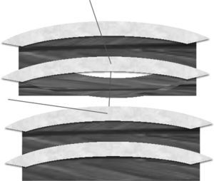 Técnica de sutura intracostal modificada: los puntos pasan a través de las costillas cefálica y caudal, y transcurren por el espacio dejado por el colgajo practicado, por encima del músculo intercostal y el paquete neurovascular; esto impide su compresión.