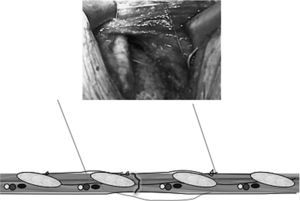Técnica de sutura pericostal modificada («al extremo»): se guía la sutura inmediatamente caudal a la costilla inferior del espacio de toracotomía, pasando entre la costilla y el paquete neurovascular, evitando su compresión.