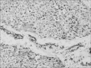 Carcinoma epidermoide con expresión negativa del antígeno del GSA y control interno positivo en el endotelio vascular. ×100.