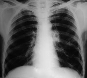 La visión posteroanterior de la radiografía de tórax en la presentación inicial demuestra la presencia de un quiste en el lóbulo inferior izquierdo.
