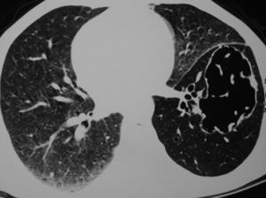 La tomografía computarizada (TC) de tórax en la presentación inicial muestra un quiste de forma irregular y pared fina junto con una disminución generalizada de la atenuación en el lóbulo inferior izquierdo.