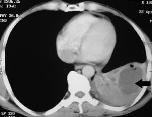 La tomografía computarizada (TC) de tórax 2 meses después de la TC inicial demuestra el colapso completo del lóbulo inferior izquierdo que también contenía el quiste lleno de líquido colapsado (flecha negra).
