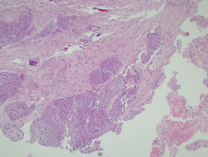 La microfotografía de la muestra de biopsia endobronquial revela un carcinoma de células escamosas (tinción con hematoxilina-eosina; ×40).