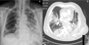 La radiografía de tórax posteroanterior (A) y la tomografía axial computarizada (B) muestran infiltrado extenso alveolar de predominio en hemitórax izquierdo y varias colecciones pleurales organizadas en un paciente con empiema por Legionella pneumophila.