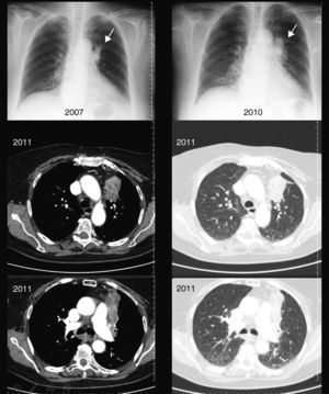 La radiografía y la TAC torácica del caso 2 muestran masa-atelectasia del lóbulo superior izquierdo.