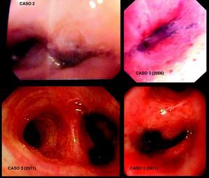 Las imágenes endoscópicas de los casos 2 y 3 muestra máculas y masa negro-violácea de aspecto antracótico y estenosis de embocadura del lóbulo inferior izquierdo (caso 2) y la embocadura anterior y ápico-posterior de lóbulo superior izquierdo (caso 3).