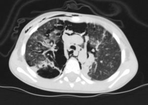 En la TC torácica se observa un enfisema intersticial en ambos pulmones (con áreas de enfisema focal en el campo medio del pulmón derecho) y un neumomediastino difuso con enfisema subcutáneo relacionado.