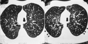 En la tomografía computarizada de alta resolución (TCAR) inspiratoria (A) y espiratoria (B) del mismo paciente de la figura 1 se aprecia una disminución de la atenuación del parénquima pulmonar en la periferia (puntas de flecha), que se acentúa en la imagen espiratoria (B) y sugiere un atrapamiento de aire. Se observa asimismo el cayado aórtico en el lado derecho y bronquiectasias quísticas en el segmento posterior del lóbulo superior derecho, que presenta una reducción de su dimensión en la imagen obtenida en espiración (flecha). Se observan también nódulos centrolobulillares difusos con aspecto de «árbol en brote» y bronquios ectásicos difusos con paredes engrosadas.