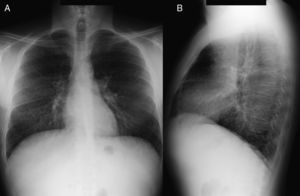 Radiografía de tórax en proyección posteroanterior (A) y lateral (B). Patrón reticular de predominio en bases.
