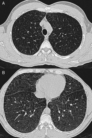 A y B) Tomografía axial computarizada de alta resolución. Opacidades en vidrio deslustrado con engrosamiento de septos interlobulillares de predominio en los lóbulos inferiores, compatibles con patrón en crazy paving con gradiente ápico-basal.