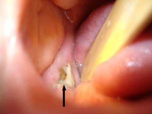 Zona de hueso al descubierto en la parte posterior de la mandíbula derecha (flecha negra).