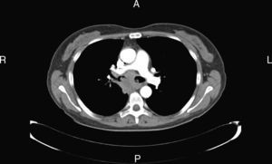 TC torácica: adenopatía subcarinal y ocupación de ambos bronquios principales con oclusión del bronquio del lóbulo medio y del lóbulo inferior derecho.