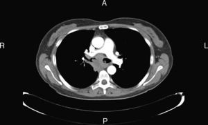 TC torácica: adenopatía subcarinal y ocupación de ambos bronquios principales con oclusión del bronquio del lóbulo medio y del lóbulo inferior derecho.