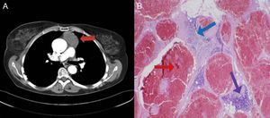A) En la tomografía computarizada toracoabdominal se evidencia una masa de partes blandas prevascular (flecha roja). B) En el estudio anatomopatológico de la pieza quirúrgica se evidencian canales vasculares dilatados llenos de sangre y revestidos por endotelio plano sin atipias (flecha roja), septos fibrosos que atraviesan la lesión (flecha azul) y tejido tímico de aspecto normal en la periferia (flecha violeta), compatible con hemangioma cavernoso tímico.