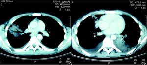 La tomografía computarizada torácica del paciente antes del tratamiento muestra tanto infiltrados pulmonares como derrames pleurales.